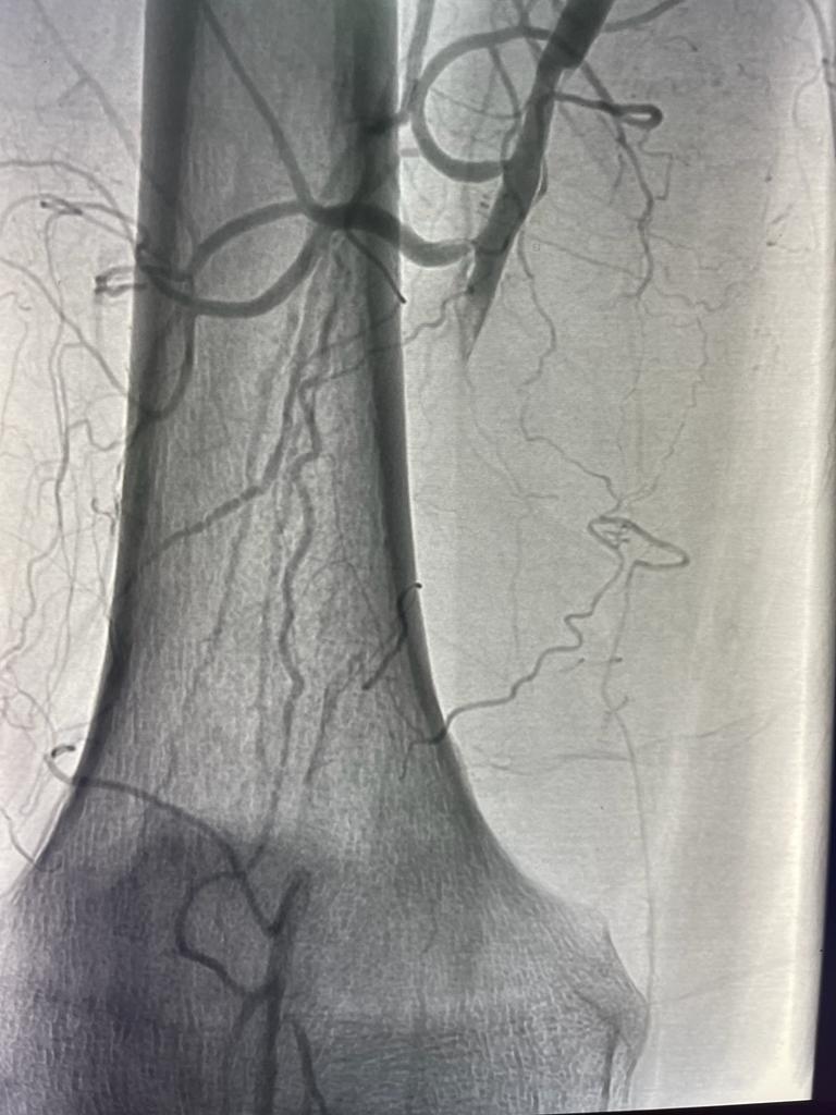 Cirurgia Endovascular Dr. Alexandre Lobue